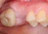 Single implant to replace upper molar