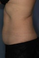 Female treated for Abdominal Fat