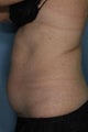 Female treated for Abdominal Fat