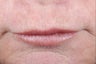 Female Lip Augmentation