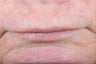 Female Lip Augmentation
