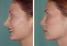 Female Revision Rhinoplasty