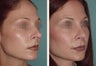 Female Revision Rhinoplasty