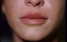 Lip Enlargement with Fillers (JUVEDERM)