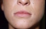 Lip Enlargement with Fillers (JUVEDERM)