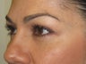 Side profile demonstrate the improvement in the tear trough deformity (orbital rim hollowing) and midface volume.