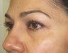 Side profile demonstrate the improvement in the tear trough deformity (orbital rim hollowing) and midface volume.
