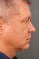 Male Chin Implant
