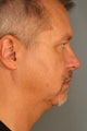 Male Chin Implant
