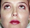 26 Year-Old Female Treated For Chubby Cheeks