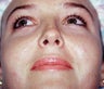 26 Year-Old Female Treated For Chubby Cheeks