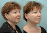 Facelift & Upper Eyelid Surgery