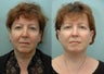 Facelift & Upper Eyelid Surgery