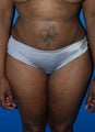 Revision of liposuction