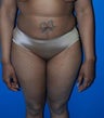 Revision of liposuction