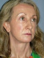 Chin Augmentation on 53-year-old