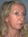 Chin Augmentation on 53-year-old