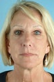 55 Year Old Female Treated for Unwanted Facial Lines