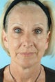 55 Year Old Female Treated for Unwanted Facial Lines