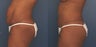 Circumferential Tummy Tuck
