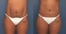 Circumferential Tummy Tuck