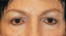 Eye Bag Surgery