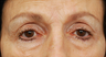 Eye Bag Surgery