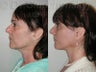 Minimally Invasive Facelift