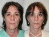 Minimally Invasive Facelift