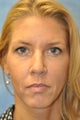 44 Year Old Female Treated for Unwanted Facial Lines