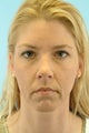 44 Year Old Female Treated for Unwanted Facial Lines