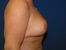 Breast Lift