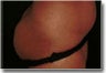 Buttocks