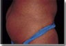 Buttocks