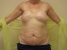 Breast Reconstruction after mastectomy