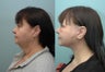 Facelift