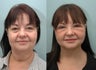 Facelift