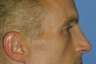 Wrinkle Treatment