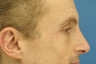 Wrinkle Treatment