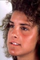 Revision rhinoplasty