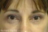 Blepharoplasty opens the eyes