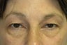 Blepharoplasty opens the eyes