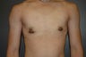 Bilateral subcutaneous mastectomies through infra areolar approach, ("keyhole").