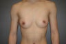 Bilateral subcutaneous mastectomies through infra areolar approach, ("keyhole").