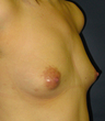 Breast Augmentation