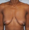 32 Years old female underwent Breast Lift with Implants Surgery