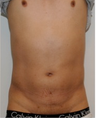 Male Liposuction Before and After - 3 Months