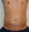 Male Liposuction Before and After - 3 Months