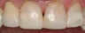 Fillings to Restore Chipped Teeth