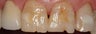 Fillings to Restore Chipped Teeth